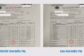 Đau xương cụ ông 78 tuổi không ngờ đa u tủy xương