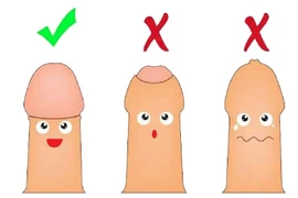 90% bé trai dưới 3 tuổi chưa thể tuột bao quy đầu