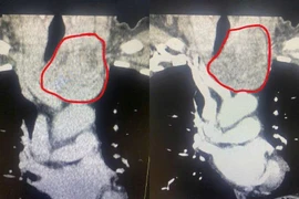Lấy u tuyến giáp thòng xuống trung thất không cưa xương ức