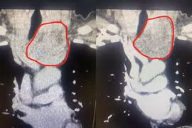 Lấy u tuyến giáp thòng xuống trung thất không cưa xương ức