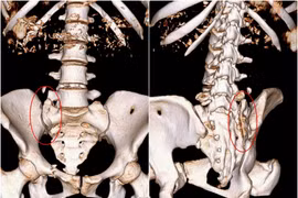 Nắn chỉnh kết hợp xương cứu cô gái nguy kịch do nhảy cầu