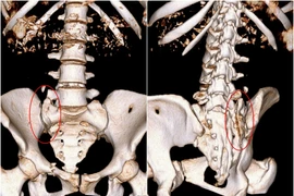 Nắn chỉnh kết hợp xương cứu cô gái nguy kịch do nhảy cầu
