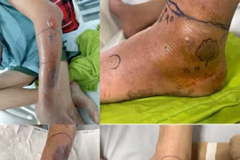 Mùa rắn sinh sản, nguy cơ rắn độc cắn gia tăng