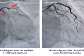 Cụ bà 78 tuổi bất ngờ ngừng tim, truy mạch nguy kịch