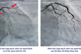 Cụ bà 78 tuổi bất ngờ ngừng tim, truy mạch nguy kịch