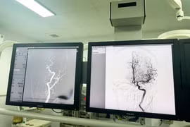 Đột quỵ não tăng khi chuyển lạnh, nhận diện sớm để cứu sống người bệnh