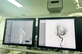 Đột quỵ não tăng khi chuyển lạnh, nhận diện sớm để cứu sống người bệnh