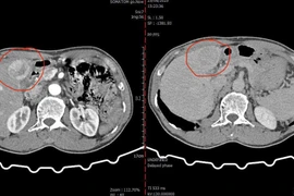 Nút mạch hóa chất cứu người bệnh bị ung thư gan nặng