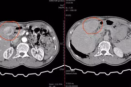 Nút mạch hóa chất cứu người bệnh bị ung thư gan nặng