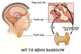 Bác sĩ mách cách điều trị tránh tái phát bệnh Basedow