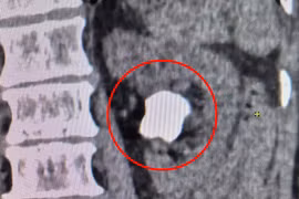 Xử trí sỏi thận lớn 4cm cho cụ ông 71 tuổi bằng kỹ thuật tán sỏi qua da