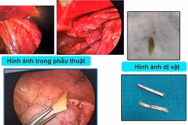 Liên tiếp 2 trường hợp bệnh nhi viêm phúc mạc do mảnh xương lợn đâm thủng ruột non