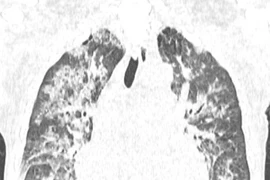 Tổn thương phổi - nguyên nhân hàng đầu gây tử vong liên quan tới truyền máu