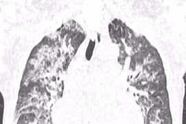 Tổn thương phổi - nguyên nhân hàng đầu gây tử vong liên quan tới truyền máu