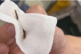 Đau tai dữ dội do rết sống 5 cm di chuyển trong ống tai