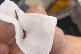 Đau tai dữ dội do rết sống 5 cm di chuyển trong ống tai