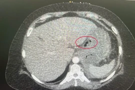 Xương cá đâm thủng, tạo mủ cả tháng trong dạ dày bệnh nhân 56 tuổi