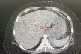 Xương cá đâm thủng, tạo mủ cả tháng trong dạ dày bệnh nhân 56 tuổi