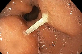 Suýt biến chứng nguy hiểm vì hóc xương cá mà không biết