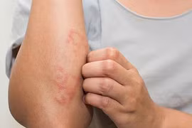 Giun lươn trong cơ thể nguy hiểm hơn ngoài da