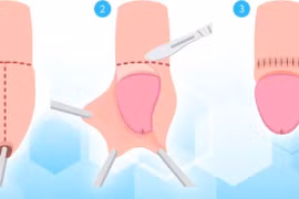 Suýt hoại tử cậu nhỏ vì tự lộn bao quy đầu