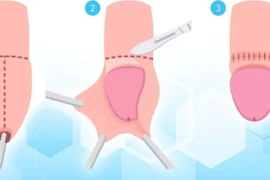 Suýt hoại tử cậu nhỏ vì tự lộn bao quy đầu