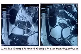 Đau bụng đi khám bất ngờ phát hiện có 2 tử cung, 1 quả thận