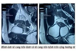 Đau bụng đi khám bất ngờ phát hiện có 2 tử cung, 1 quả thận