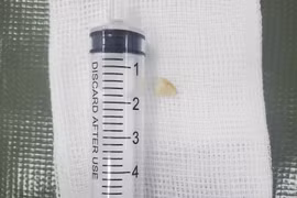 Trẻ ho sốt, không ngờ hạt lạc trong phế quản gốc trái