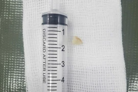 Trẻ ho sốt, không ngờ hạt lạc trong phế quản gốc trái