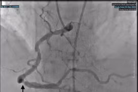 Cảnh báo nhồi máu cơ tim ở người lớn tuổi mắc nhiều bệnh nền phức tạp