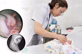 Phẫu thuật phình đại tràng bẩm sinh cho trẻ sơ sinh 30 ngày tuổi nhẹ cân