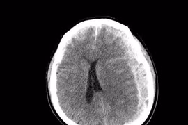 1 giờ sau ngã tại nhà, cụ ông 70 tuổi nhanh chóng hôn mê