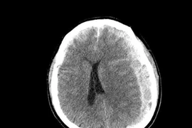 1 giờ sau ngã tại nhà, cụ ông 70 tuổi nhanh chóng hôn mê