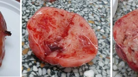 Điều trị ung thư tái phát hiệu quả nhờ phối hợp đa mô thức