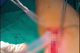 Báo động đỏ tiêm truyền tại cơ sở không đảm bảo gây áp xe nghiêm trọng