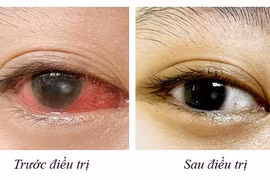 4 năm đeo kính áp tròng, người phụ nữ loét giác mạc phải nhập viện