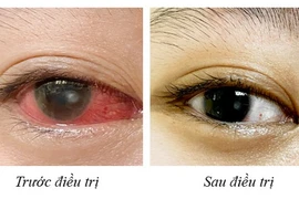 4 năm đeo kính áp tròng, người phụ nữ loét giác mạc phải nhập viện