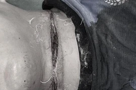 Cứu sống bệnh nhân bị dây thép trên đường cứa ngang cổ nguy kịch