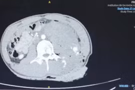 Mâu thuẫn nhỏ, thanh niên 19 tuổi bị đâm từ hông lưng đến bụng dài 15 cm