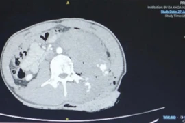 Mâu thuẫn nhỏ, thanh niên 19 tuổi bị đâm từ hông lưng đến bụng dài 15 cm