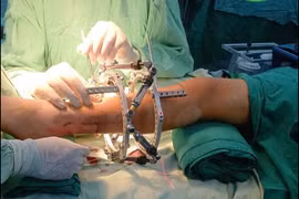 Thiểu xương mác dẫn tới hàng loạt biến dạng ở chi dưới