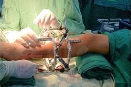 Thiểu xương mác dẫn tới hàng loạt biến dạng ở chi dưới