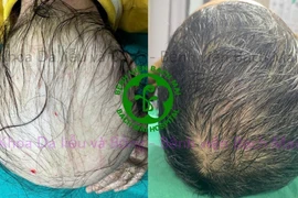 Chăm sóc tóc đúng cách, tránh tổn thương nang tóc lâu dài