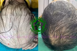 Chăm sóc tóc đúng cách, tránh tổn thương nang tóc lâu dài