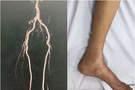 Cụ ông 84 tuổi suýt phải cắt cụt 2 chân do tắc mạch chi nặng nề