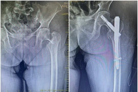 Biến chứng nguy hiểm do gãy liên mấu chuyển xương đùi