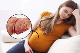 Thay máu toàn cơ thể cứu thai phụ gan nhiễm mỡ cấp tính nặng