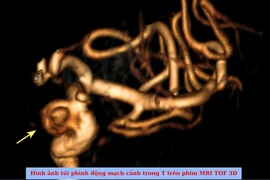Khám sức khỏe định kỳ, người phụ nữ phát hiện túi phình mạch máu não lớn
