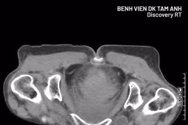 Cụ bà 77 tuổi nguy kịch vì thoát vị bịt